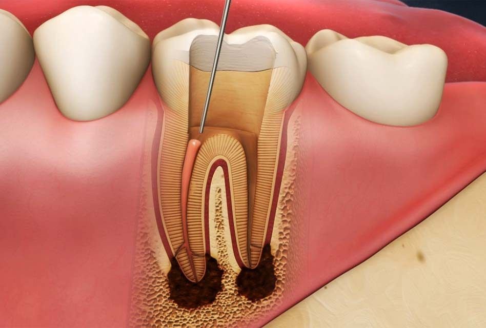 Endodontic Treatment