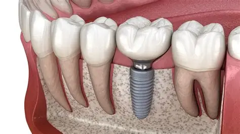 Implant Dentistry