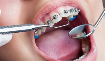 Orthodontic Treatment